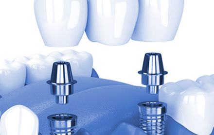 implantes dentales precios